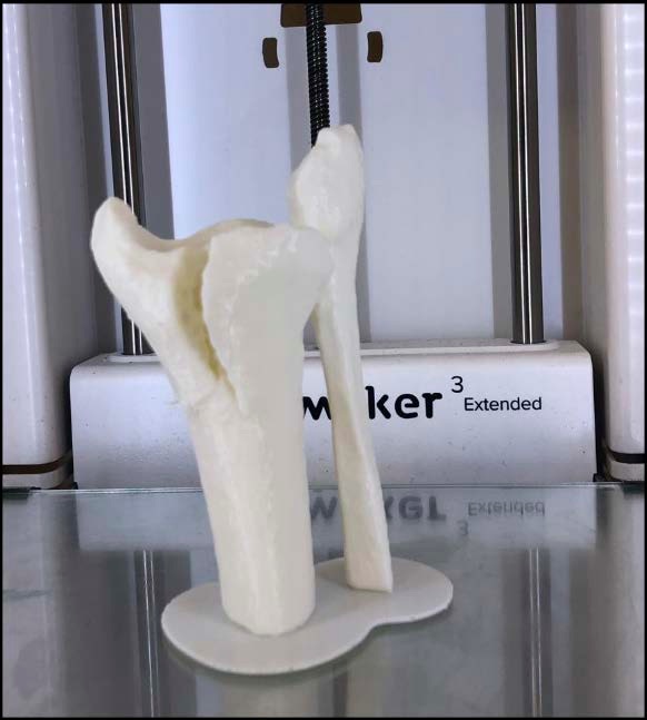 Modelo 3D impreso de fractura de pilón tibial obtenido a partir de la segmentación