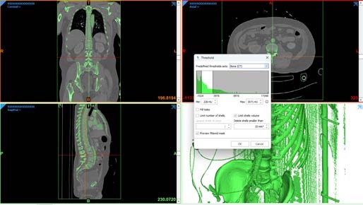 Ventana de la herramienta Threshold de MIMICS con el preset Bone (CT)
