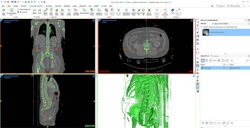 Máscara creada tras aplicar la herramienta Threshold sobre la pelvis