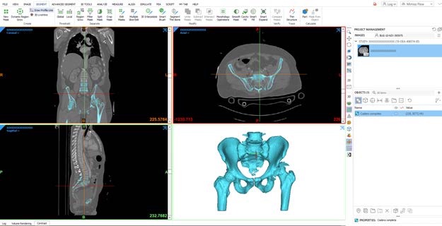 Resultado deseado de la cadera tras limpiar la imagen de artefactos