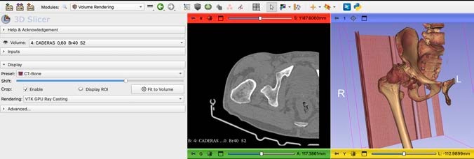 Renderizado 3D de la pelvis con el preset CT-AAA