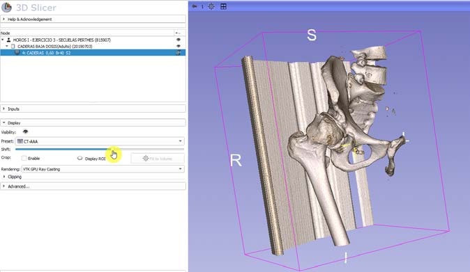 Ajuste del rectángulo ROI sobre las vistas del TC en 3D Slicer